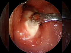 Corrente ≤ 1,5 mA Artroscopia RF Vareta de plasma Equipamentos cirúrgicos Ombro Quadril Joelho