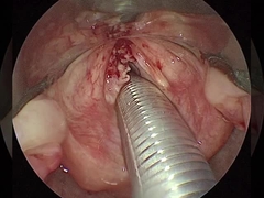 Corrente ≤ 1,5 mA Artroscopia RF Vareta de plasma Equipamentos cirúrgicos Ombro Quadril Joelho
